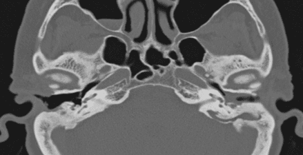 Axial CT image of the head and neck